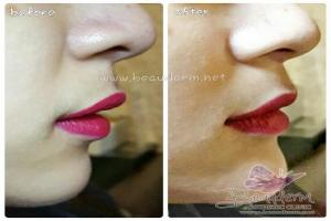 Chin Augmentation / Filler Dagu