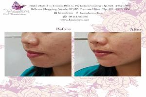 Chin Augmentation / Filler Dagu