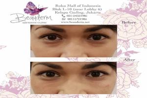 Under Eye Filler
