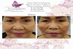 Tarik Benang (Threadlift)