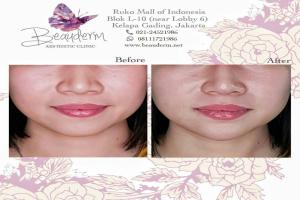 Chin Augmentation / Filler Dagu