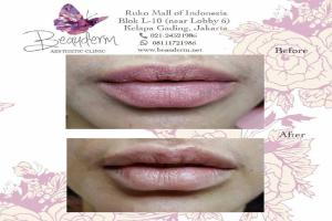 Lips Filler / Filler Bibir