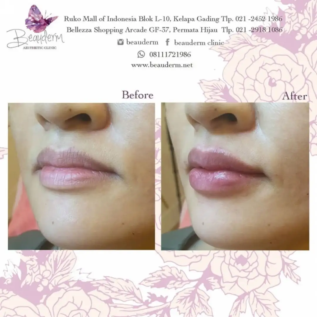 Lips Filler / Filler Bibir