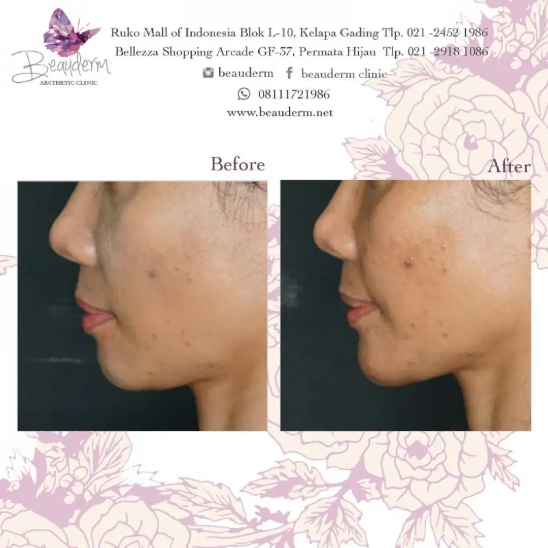 Chin Augmentation / Filler Dagu