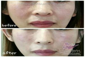 Smile Line Filler