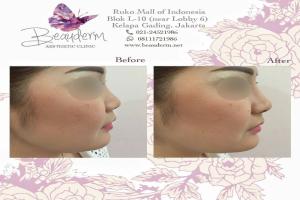 Chin Augmentation / Filler Dagu