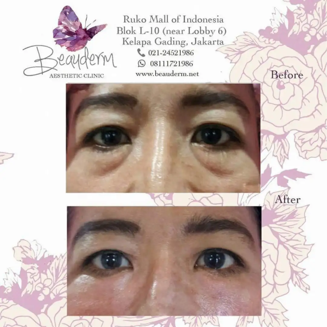 Under Eye Filler