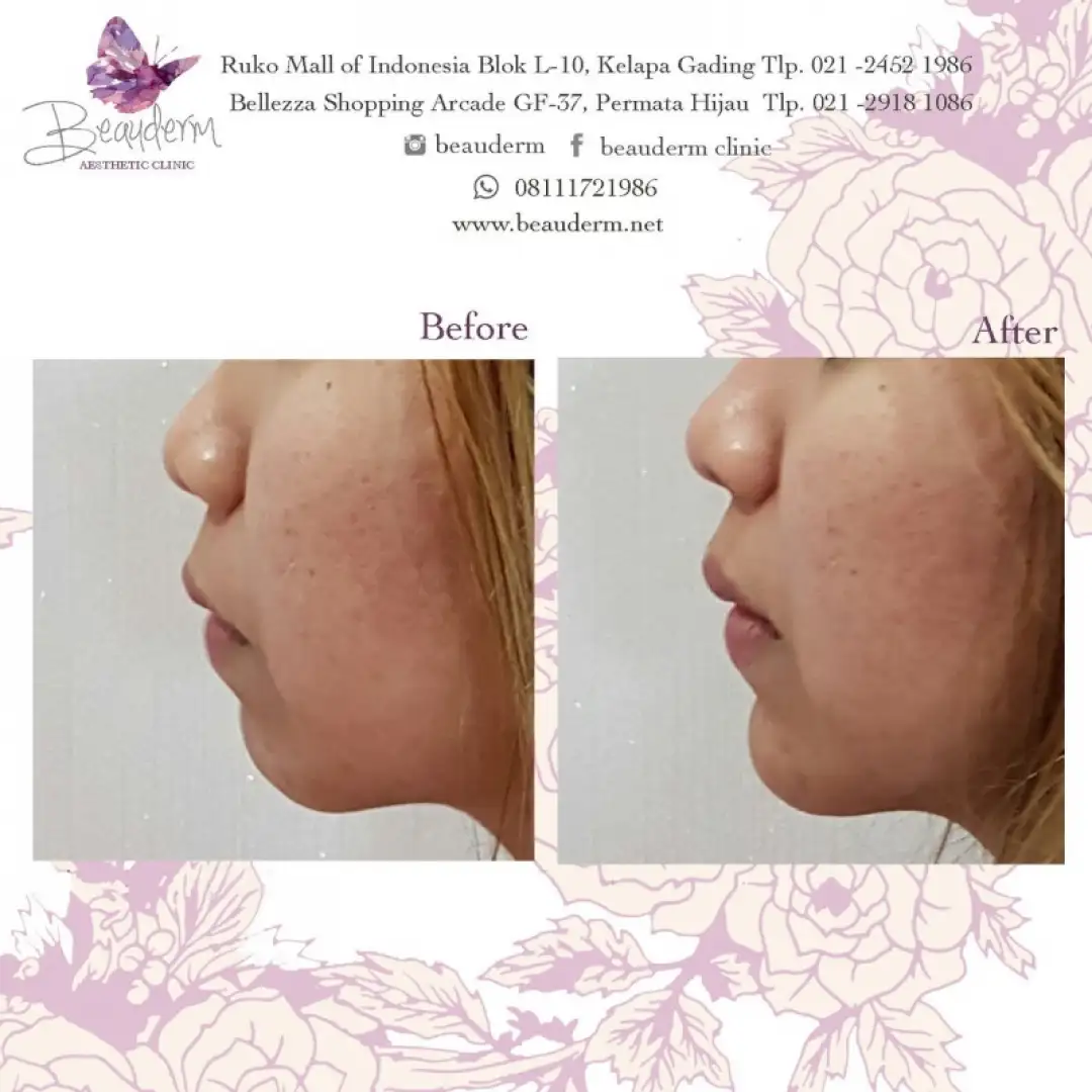 Chin Augmentation / Filler Dagu