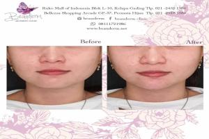 Chin Augmentation / Filler Dagu