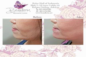 Chin Augmentation / Filler Dagu