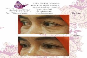 Under Eye Filler