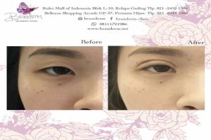 Double Eyelid Stitching