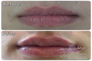 Lips Filler / Filler Bibir