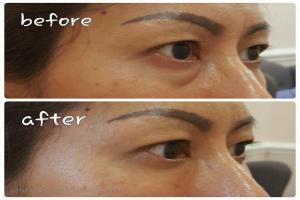 Under Eye Filler