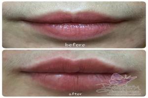 Lips Filler / Filler Bibir