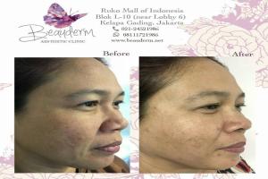 Tarik Benang (Threadlift)