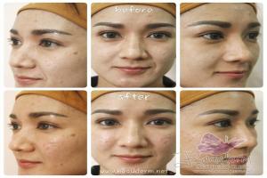 Under Eye Filler