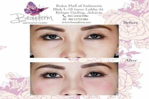 Under Eye Filler