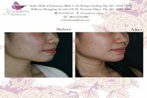 Chin Augmentation / Filler Dagu