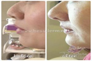 Chin Augmentation / Filler Dagu