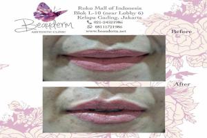 Lips Filler / Filler Bibir