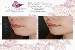 Chin Augmentation / Filler Dagu