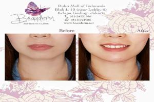 Chin Augmentation / Filler Dagu