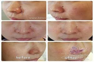 Under Eye Filler