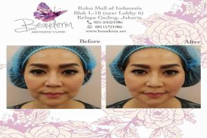 Tarik Benang (Threadlift)