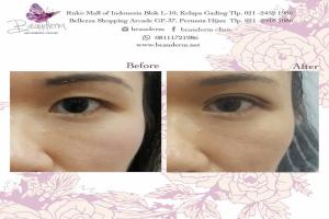 Double Eyelid Stitching