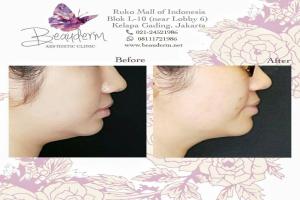 Chin Augmentation / Filler Dagu