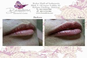 Lips Filler / Filler Bibir