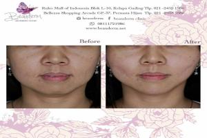 Chin Augmentation / Filler Dagu