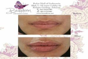 Lips Filler / Filler Bibir