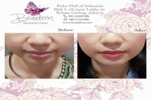 Chin Augmentation / Filler Dagu