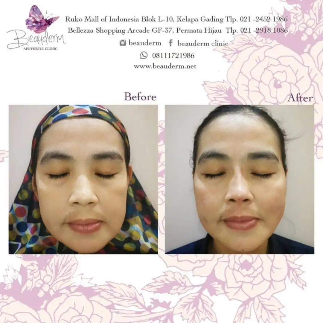 Tarik Benang (Threadlift)