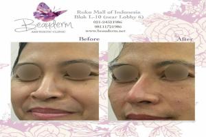 Under Eye Filler