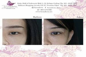 Double Eyelid Stitching