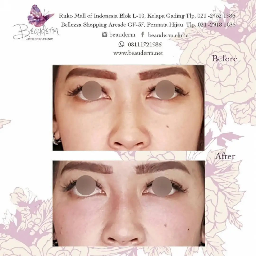 Under Eye Filler