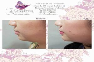 Chin Augmentation / Filler Dagu