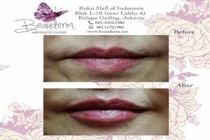 Lips Filler / Filler Bibir