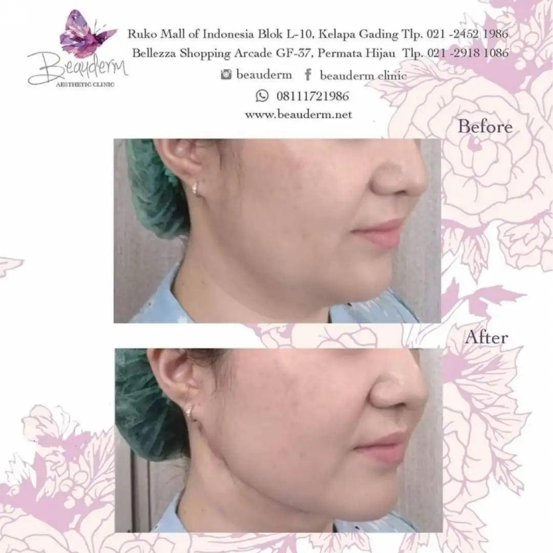 Chin Augmentation / Filler Dagu