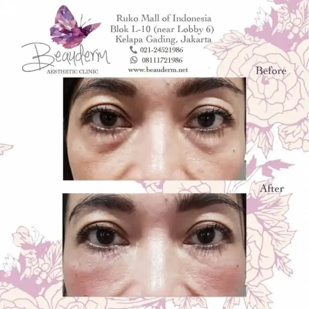 Under Eye Filler