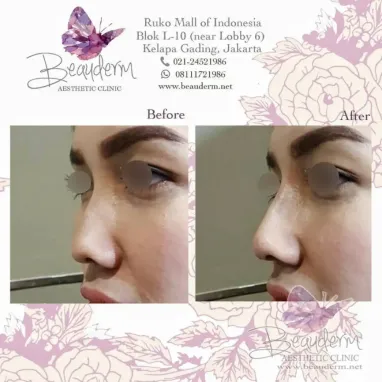 gallery img: Filler Hidung / Nose Filler
