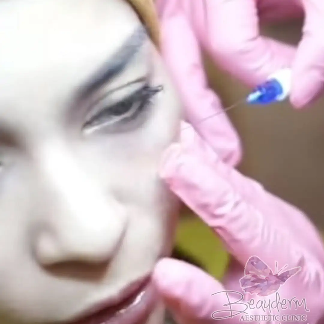 Under Eye Filler Treatment