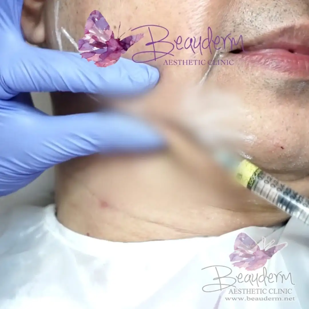 Filler Garis Rahang Bentuk Lebih Ideal Maskulin Feminin (Jawline)