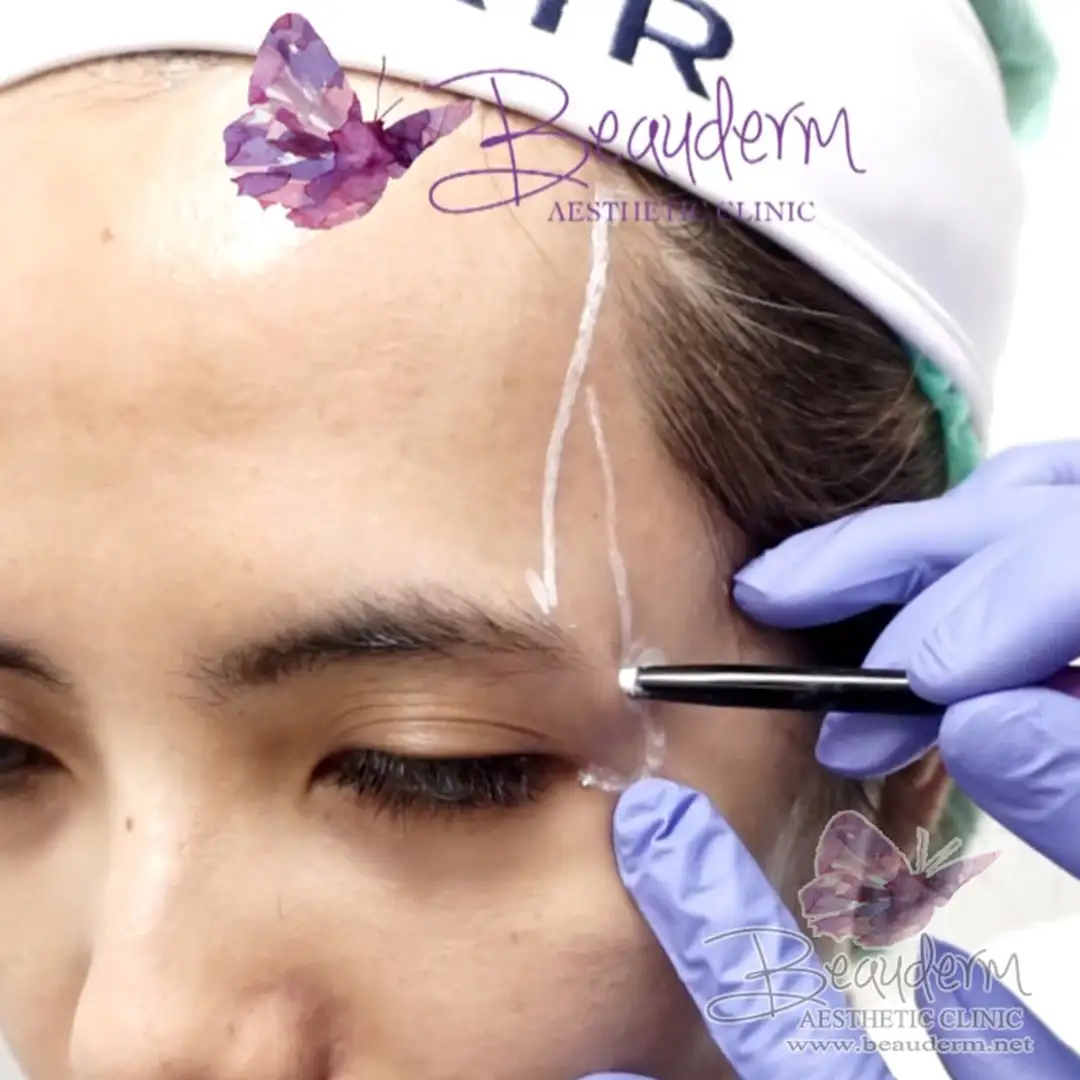 Mengurangi Memperbaiki Kerutan Area Pelipis Cekung (Proses Suntik Filler Temporal)