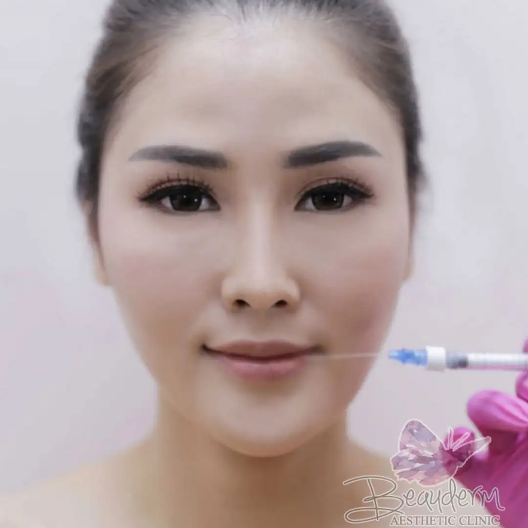 Lips Augmentation