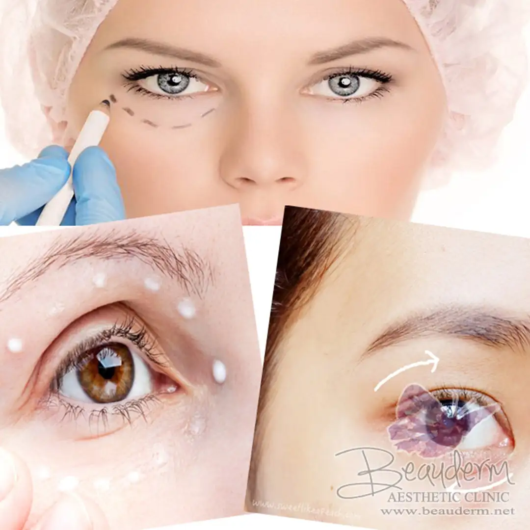 Terlihat Makin Menarik & Bebas Kantung Mata (Eye Bag)