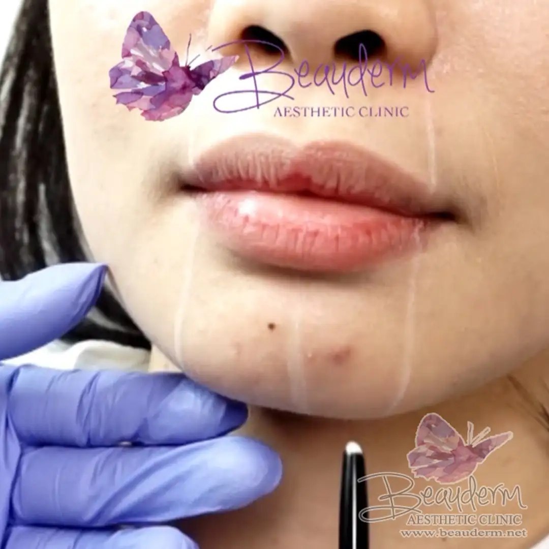 Augmentasi Chin Filler Memperbaiki Bentuk Ukuran Dagu